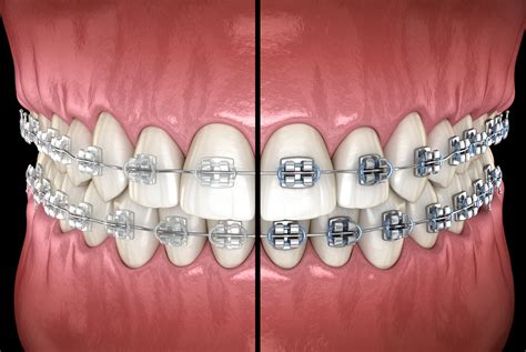 metal and ceramic brackets|traditional metal braces vs ceramic.